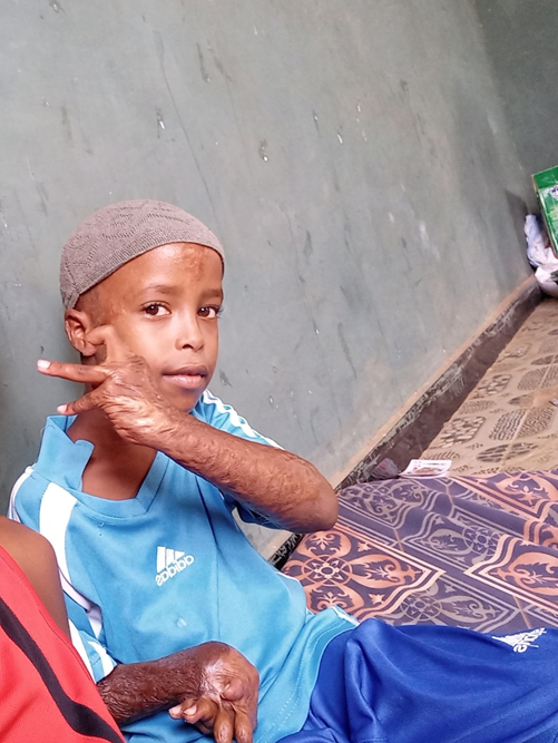 My little brother skin surgery